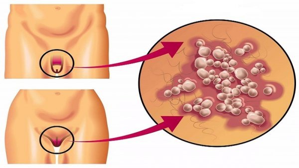  تبخال تناسلی بدتر است یا زگیل تناسلی؟