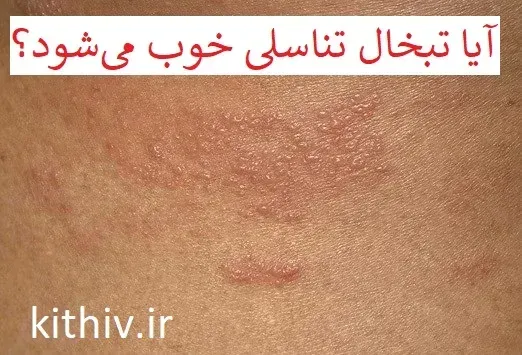  تبخال تناسلی بدتر است یا زگیل تناسلی؟