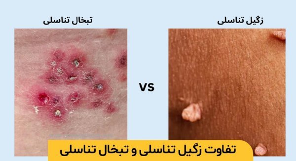  تبخال تناسلی بدتر است یا زگیل تناسلی؟