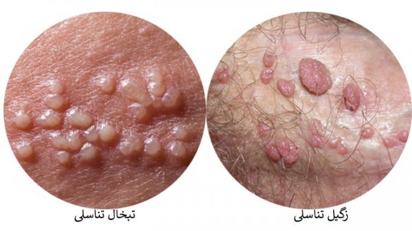  تبخال تناسلی بدتر است یا زگیل تناسلی؟