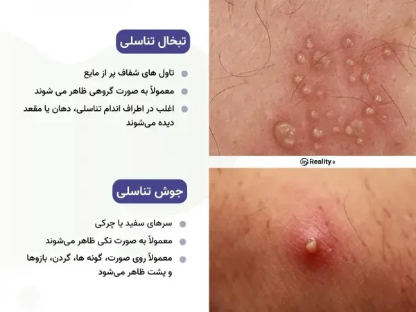  تبخال تناسلی بدتر است یا زگیل تناسلی؟