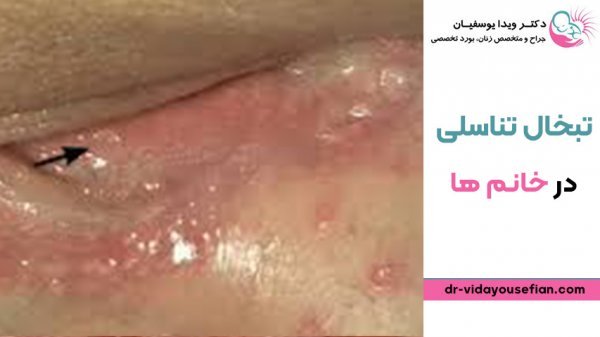  تبخال تناسلی بدتر است یا زگیل تناسلی؟