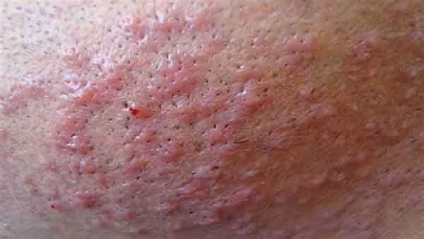 آیا جوش واژن خطرناک است؟