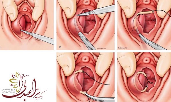  آیا جوش واژن خطرناک است؟