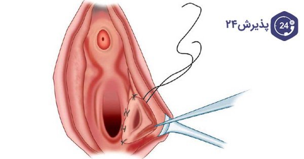  آیا جوش واژن خطرناک است؟