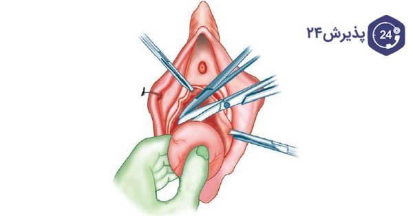  آیا جوش واژن خطرناک است؟