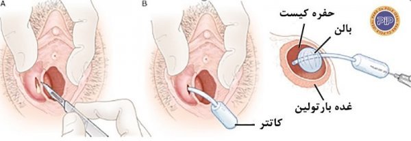  آیا جوش واژن خطرناک است؟