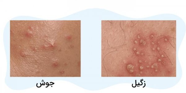  آیا جوش واژن خطرناک است؟