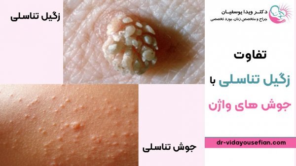  آیا جوش واژن خطرناک است؟