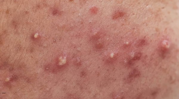  آیا جوش واژن خطرناک است؟