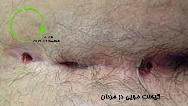  آیا جوش واژن خطرناک است؟