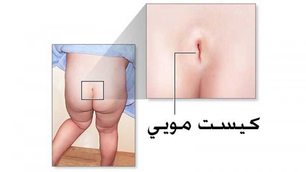  آیا کیست مویی باعث نازایی میشود؟