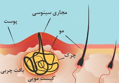  آیا کیست مویی باعث نازایی میشود؟