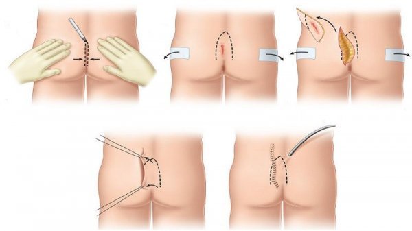  آیا کیست مویی باعث نازایی میشود؟