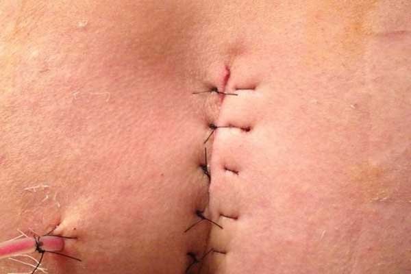  آیا کیست مویی باعث نازایی میشود؟