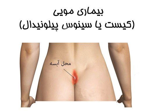  آیا کیست مویی باعث نازایی میشود؟