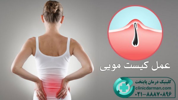  آیا کیست مویی باعث نازایی میشود؟