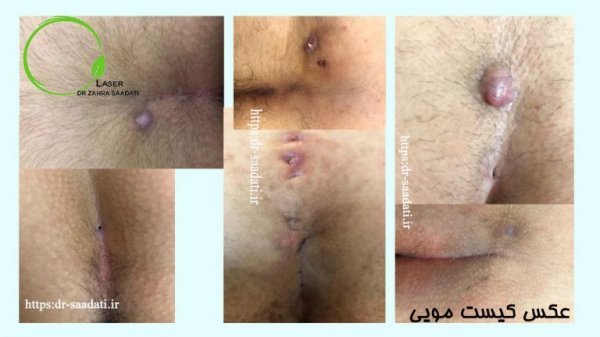  آیا کیست مویی باعث نازایی میشود؟