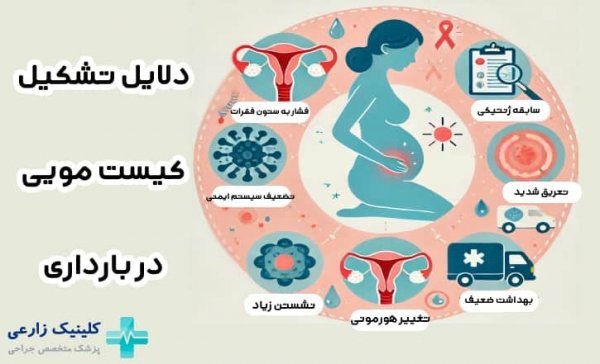  آیا کیست مویی باعث نازایی میشود؟