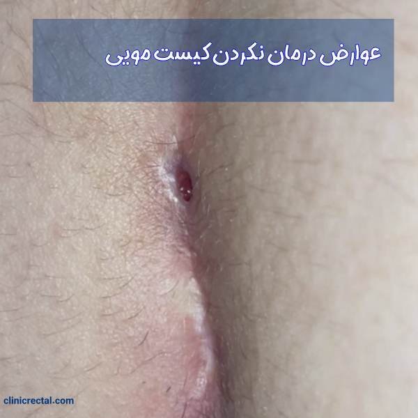  آیا کیست مویی باعث نازایی میشود؟