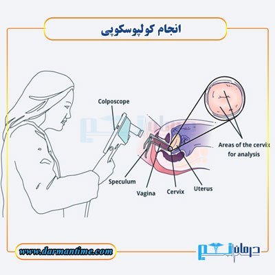  آیا کولپوسکوپی درد دارد؟