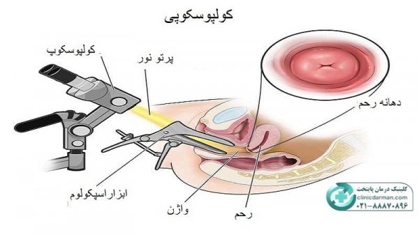  آیا کولپوسکوپی درد دارد؟