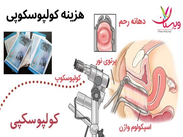 آیا کولپوسکوپی درد دارد؟