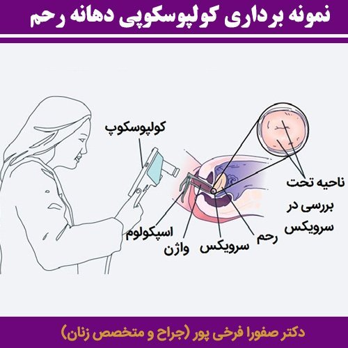  آیا کولپوسکوپی درد دارد؟