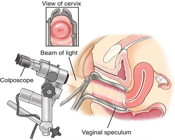  آیا کولپوسکوپی درد دارد؟