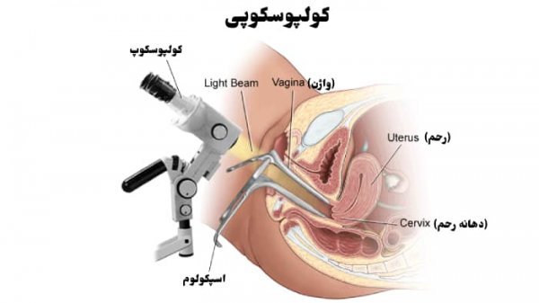  آیا کولپوسکوپی درد دارد؟