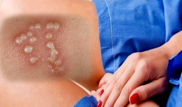  کمبود چه ویتامینی باعث تبخال می‌شود؟