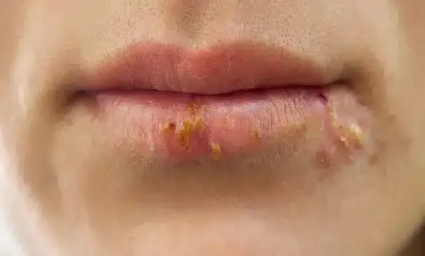  کمبود چه ویتامینی باعث تبخال می‌شود؟