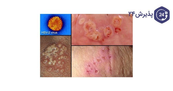  کمبود چه ویتامینی باعث تبخال می‌شود؟