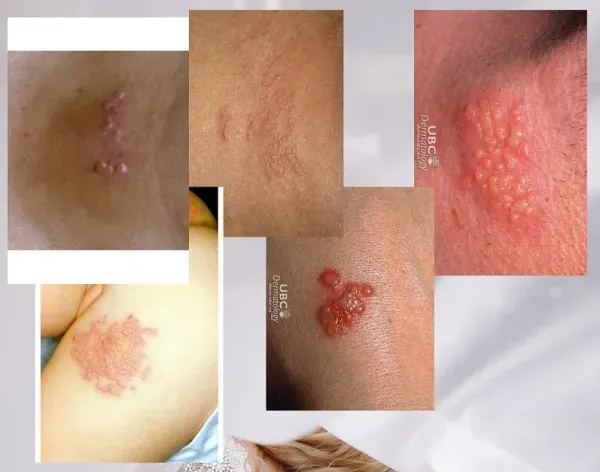  آیا تبخال تناسلی باعث تب می‌شود؟