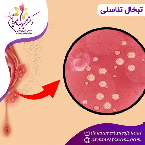  آیا تبخال تناسلی باعث تب می‌شود؟