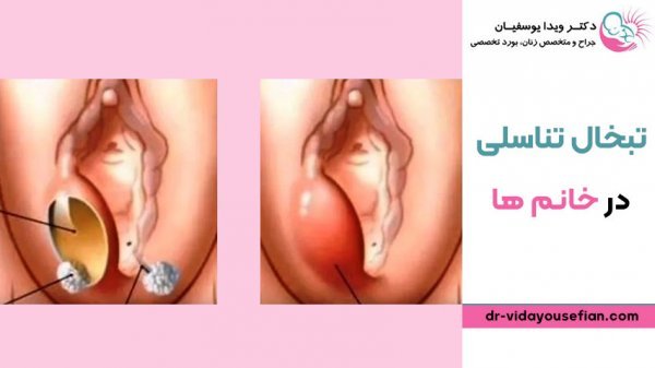  آیا تبخال تناسلی باعث تب می‌شود؟