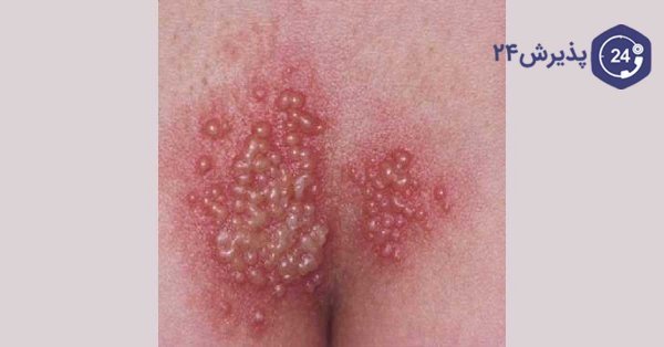  آیا تبخال تناسلی باعث تب می‌شود؟