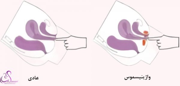  آیا واژینیسموس مانع بارداری می‌شود؟