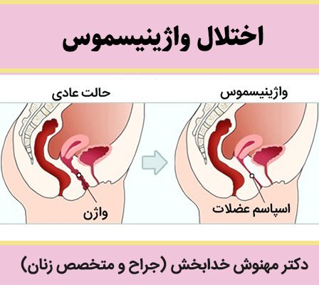  آیا واژینیسموس مانع بارداری می‌شود؟