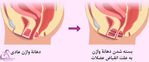  آیا واژینیسموس مانع بارداری می‌شود؟