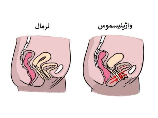  آیا واژینیسموس مانع بارداری می‌شود؟