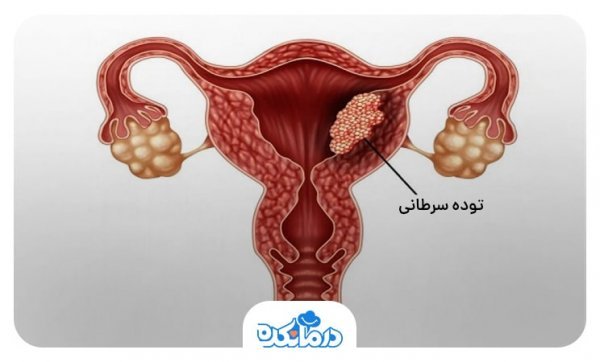  اگر تست پاپ اسمیر مثبت باشد چه می‌شود؟