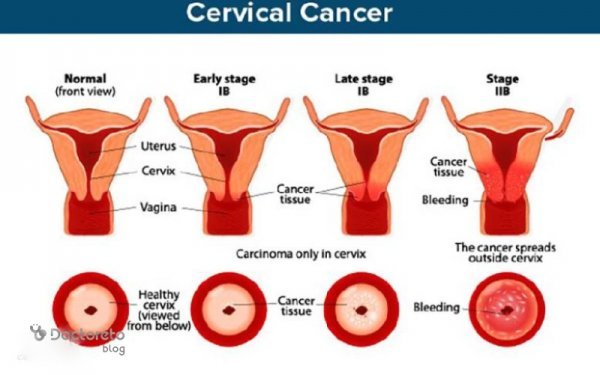  اگر تست پاپ اسمیر مثبت باشد چه می‌شود؟