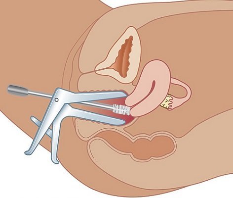 آیا تست پاپ اسمیر درد دارد؟