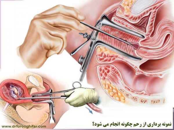  آیا تست پاپ اسمیر درد دارد؟