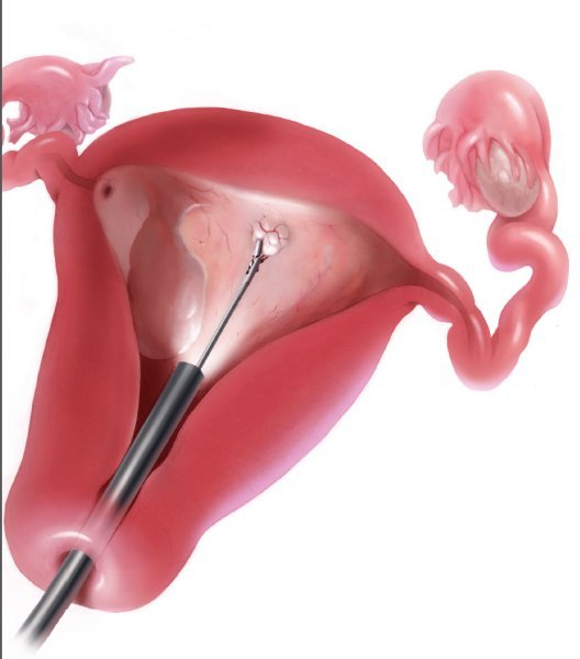  آیا تست پاپ اسمیر درد دارد؟