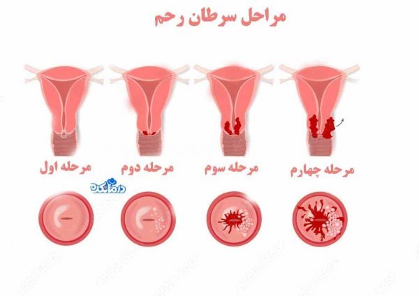  آیا تست پاپ اسمیر درد دارد؟