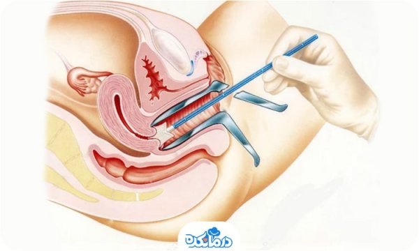  آیا تست پاپ اسمیر درد دارد؟