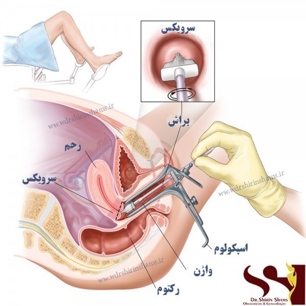  چند روز بعد از پاپ اسمیر می‌توان رابطه جنسی داشت؟
