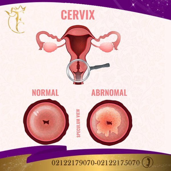  چند روز بعد از پاپ اسمیر می‌توان رابطه جنسی داشت؟